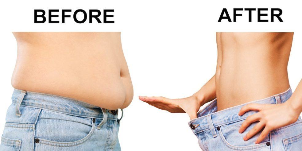 guideline health-liposuction