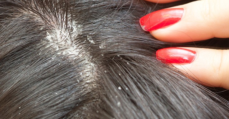Herbal Remedies To Get Rid of Head Lice