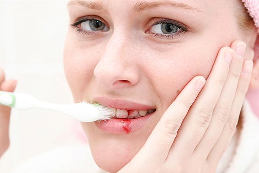 6 Causes of Bleeding Gums One Should Know
