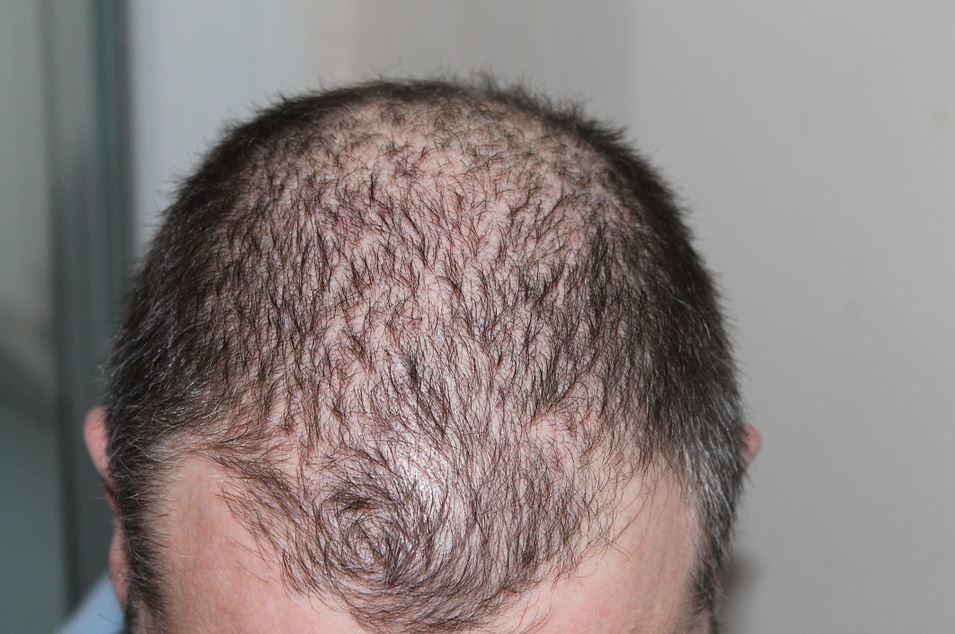 Beat Baldness: 5 Natural Ways to Prevent Hair Loss