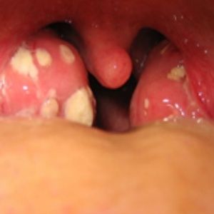 natural cures for tonsil stones