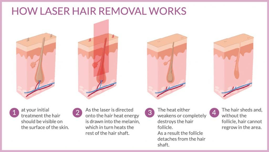 Laser Hair Removal in Mumbai, How it’s cost?