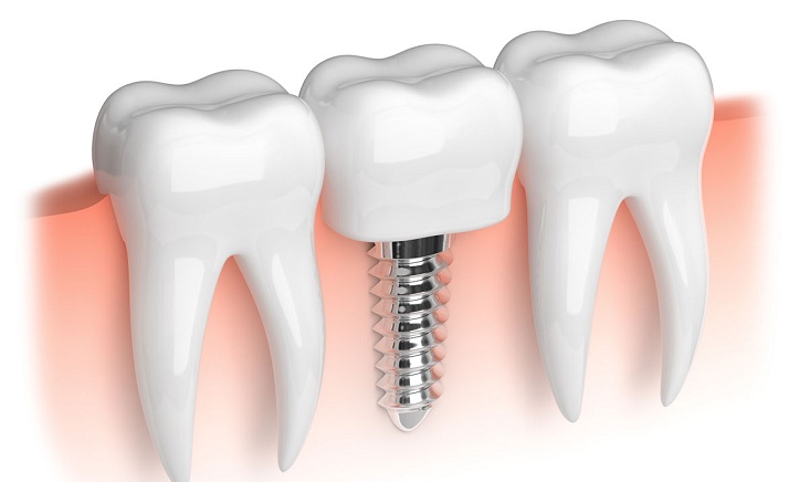 Dental Care Tips for Implants