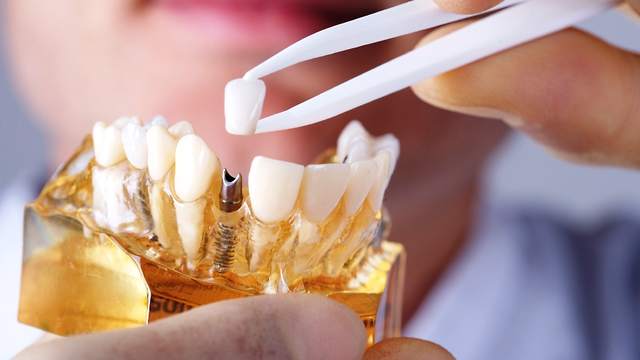 Important Things To Consider When Choosing Dental Implant Treatment