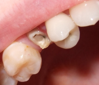 image2 - Chipped, Broken, or Inflamed: Knowing How to Handle Dental Care Issues is Important to Your Health