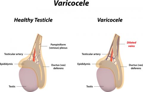 Causes Of Varicocele