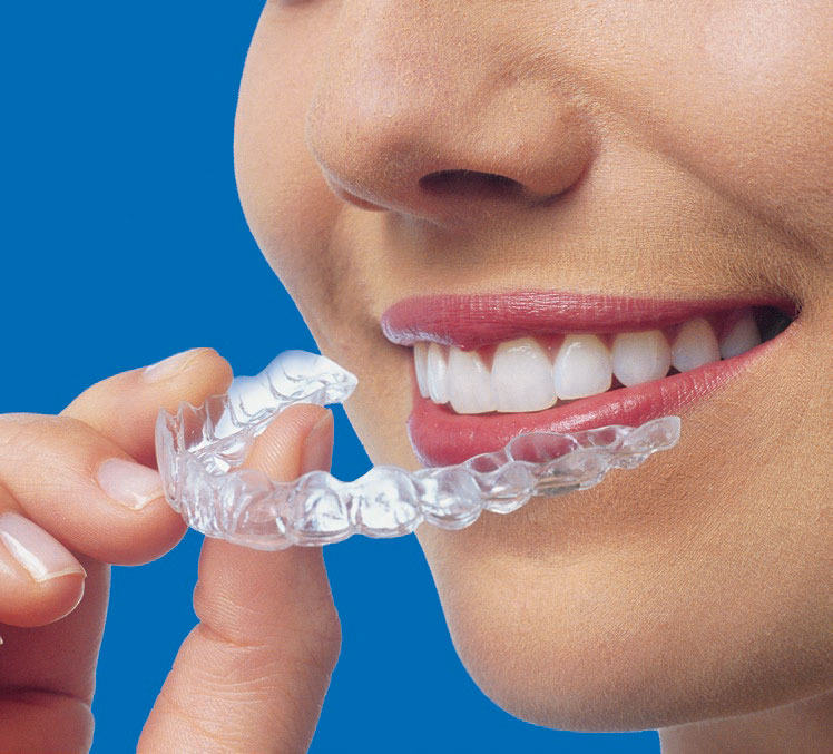 Top Five Reasons To Use Invisalign
