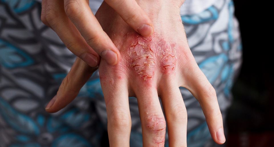 Red and Itchy Skin How to Take Care of Your Eczema