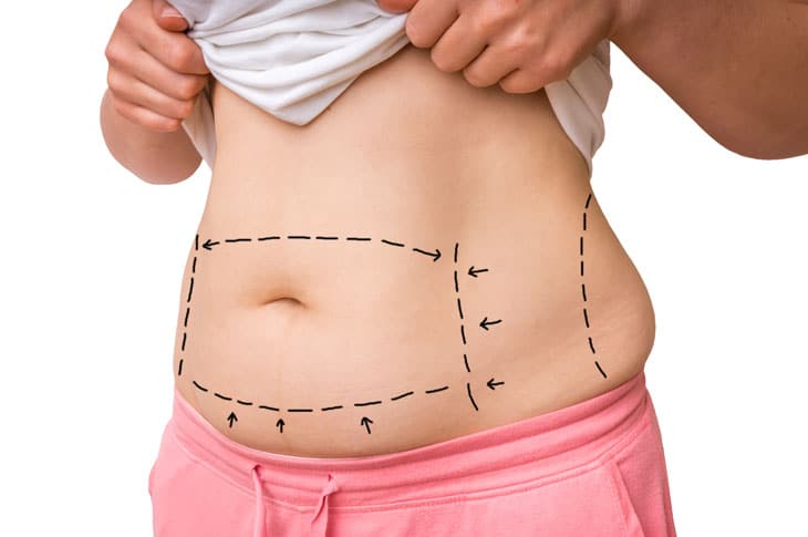 5 Things You Should Know Before You Schedule Your Tummy Tuck