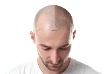 Things You Should Know Before Going for Hair Transplant in Delhi