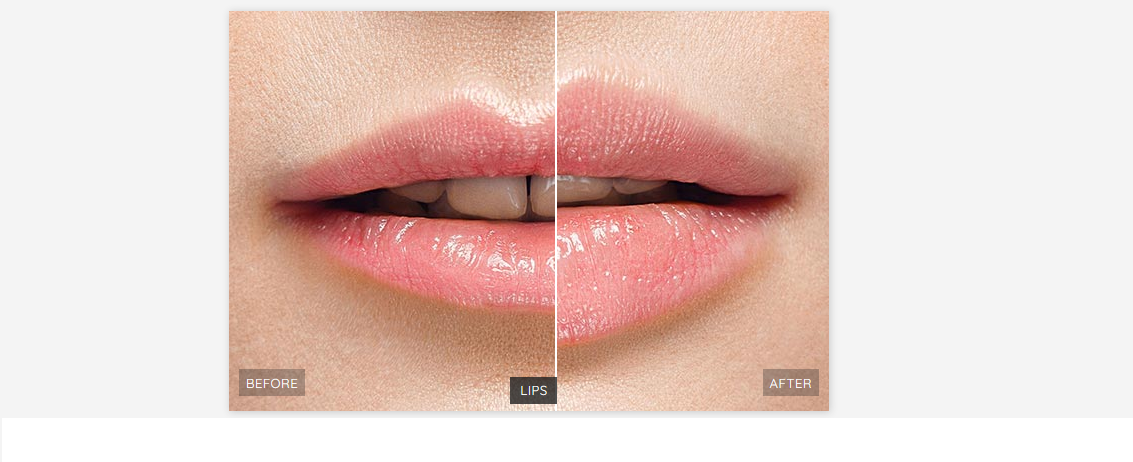 How Much Does Lip Injections Cost?