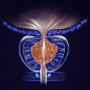 shutterstock 515911966 300x300 - What Causes An Enlarged Prostate and How To Treat It