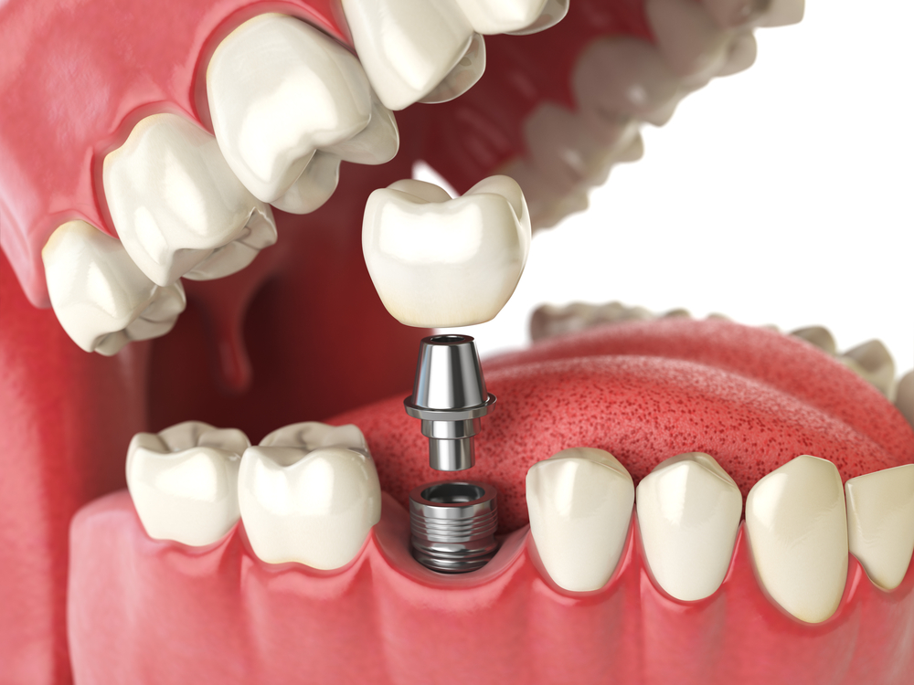 What To Expect In A Great Dental Implant Center