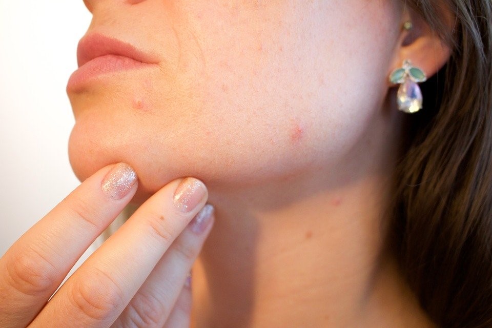 10 ways to get rid of acne