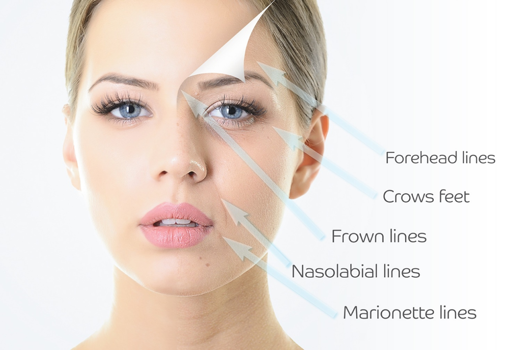 Azzalure vs. Botox: which is better?
