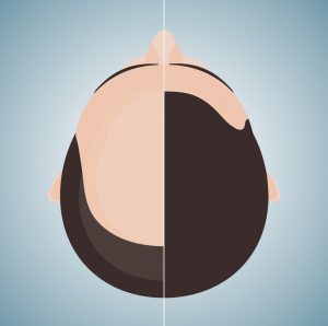 bald man before and after hair transplantation  300x298 - Hair transplant in Pune