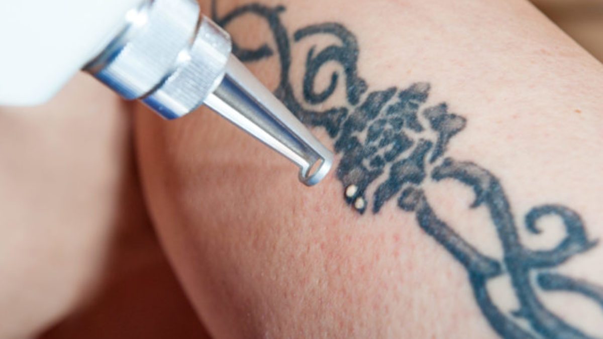 What You Should Know About Tattoo Removal