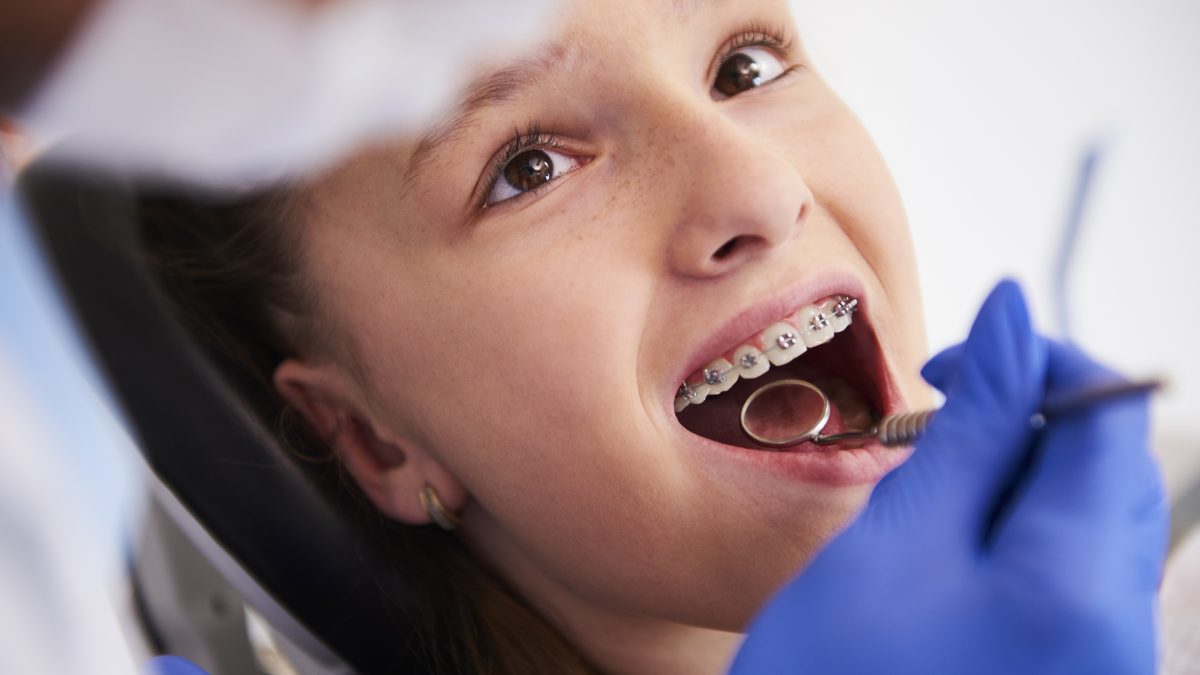 What Are the Best Types of Braces for Kids?